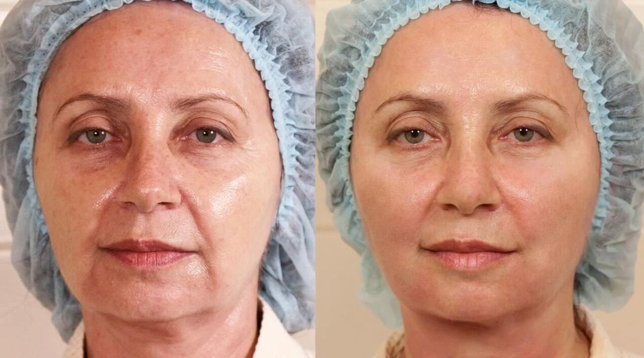 before and after photos of facelift