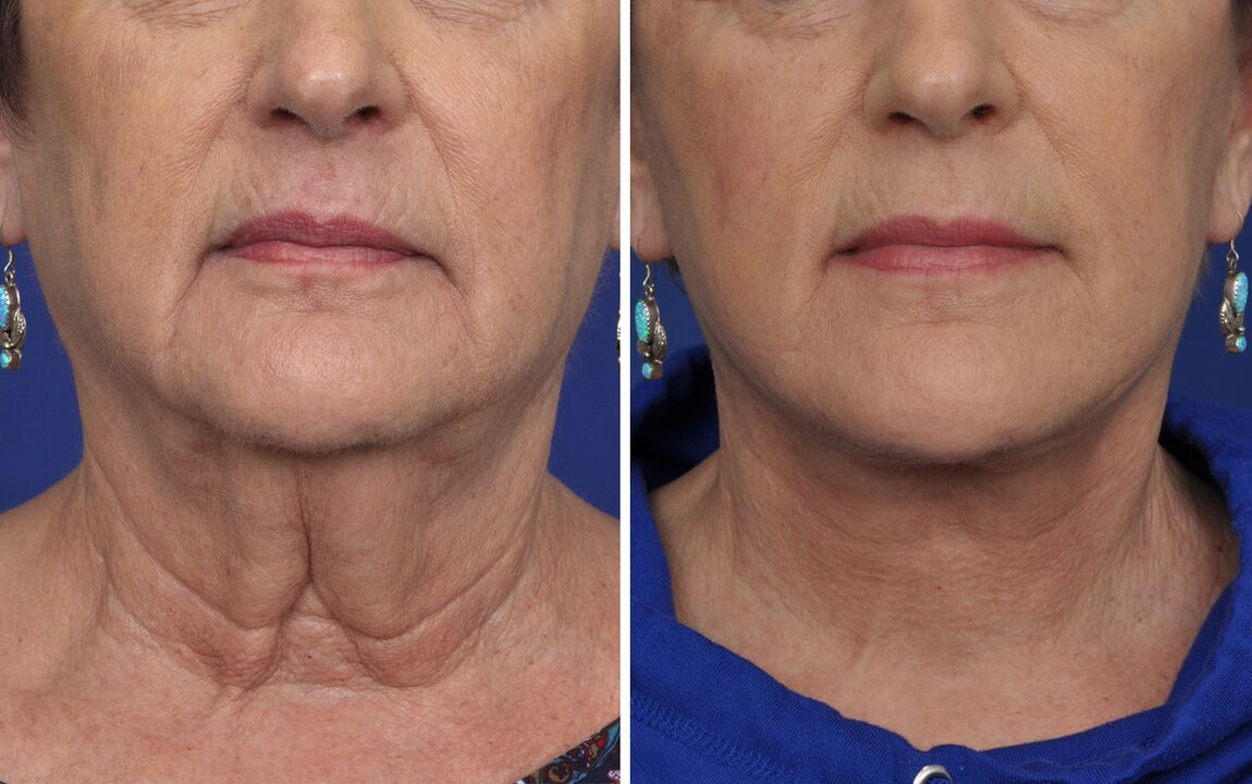 before and after skin rejuvenation treatments